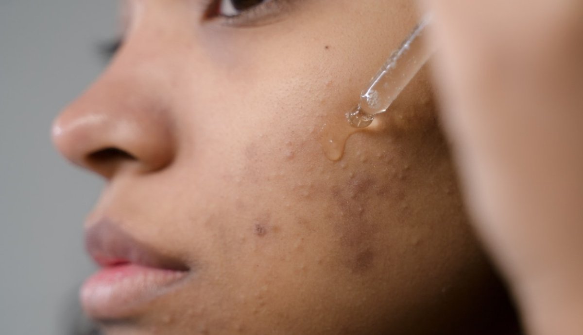 CBD For Acne: Which is Most Effective (& Does It Work for All?) - VO Inc